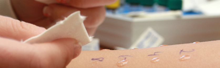 An allergy skin test being conducted